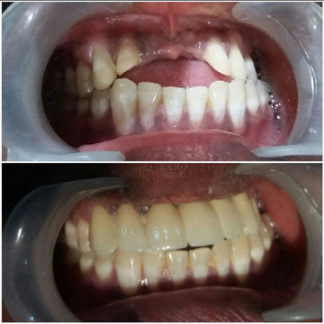 zirconium bridge